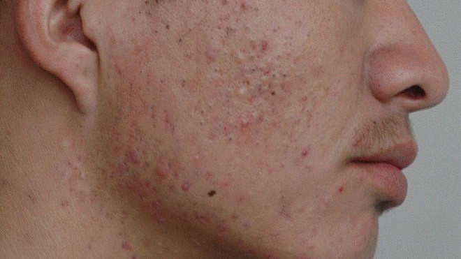 Hỏi và đáp về bệnh mụn trứng cá Điều trị mụn trứng cá cần liệu trình lâu dài.