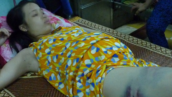 Bụng mang dạ chửa vẫn bị chồng đánh nhập viện Dù đang mang thai nhưng chị H vẫn bị người chồng đánh đập.