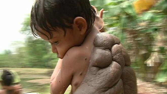 'Cậu bé rùa' mang nốt ruồi khổng lồ sau lưng Didier Montalvo và khối u khổng lồ sau lưng