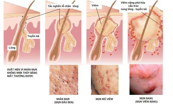 Dùng thuốc trị mụn: Coi chừng đẻ quái thai Cơ chế của mụn trứng cá.