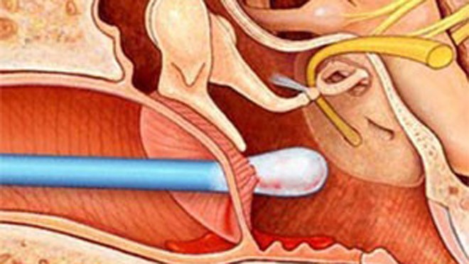 Ngoáy tai thường xuyên - Hậu quả khó lường Thủng màng nhĩ do ngoáy tai.