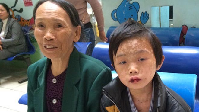 Ăn quả dại, bé trai 9 tuổi toàn thân nổi nốt nguy kịch Tín được xuất viện. Ảnh: N.Phương.