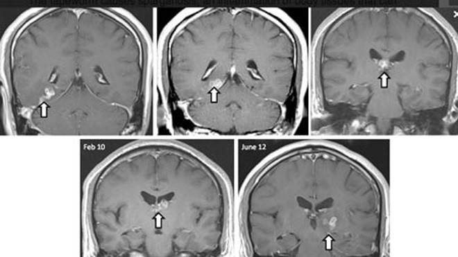 Hãi hùng sán lạ 'tung tăng' trong não suốt 4 năm Hãi hùng sán lạ 'tung tăng' trong não suốt 4 năm