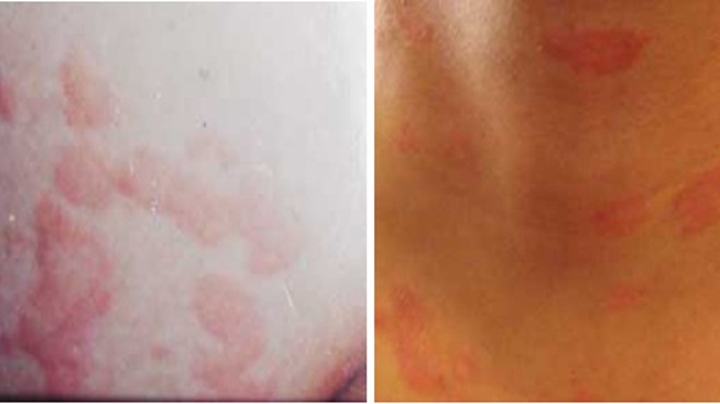 Cách trị bệnh dị ứng mề đay khi chuyển mùa Dị ứng và mề đay đang là nỗi lo không của riêng ai. Đông y Bảo Thanh Đường khi chữa trị cho bệnh nhân rất chú trọng đến việc loại bỏ được tác nhân gây dị ứng để chữa trị dứt hẳn bệnh.