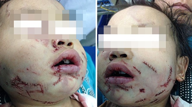 Hai bé gái bị chó tấn công Gương mặt của bé sau khi được khâu vá các vết thương. Ảnh: Bác sĩ Minh Hằng