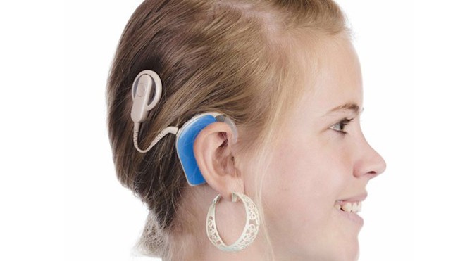 Cấy điện cực ốc tai trị điếc Người bị tổn thương màng nhĩ có thể phục hồi tốt khả năng nghe nhờ vào can thiệp y học - Ảnh: Shutterstock