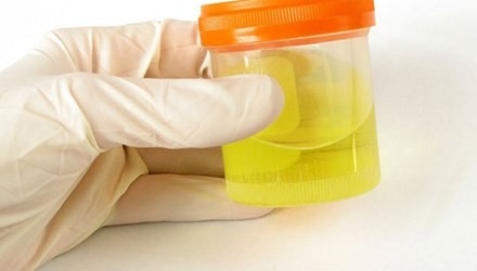 Nước tiểu cảnh báo tình trạng sức khỏe Ảnh minh họa