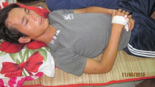 Đi bẫy chim, thanh niên bị sét đánh chết Anh Út đang nằm điều trị tại Bệnh viện Đa khoa Trà Vinh