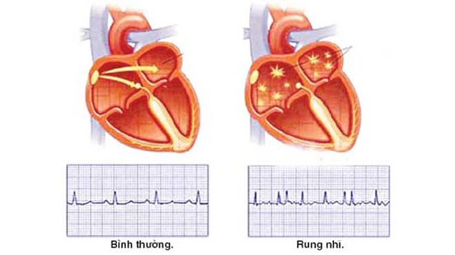 Giảm cân giúp khắc phục nhịp tim bất thường Giảm cân giúp khắc phục nhịp tim bất thường