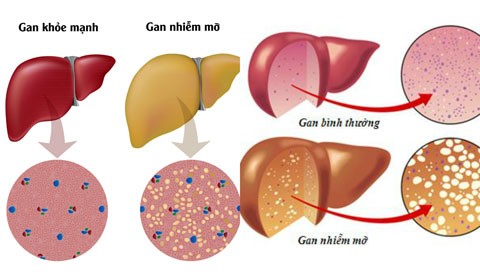 Chuyên gia mách cách tránh bị gan nhiễm mỡ Gan nhiễm mỡ