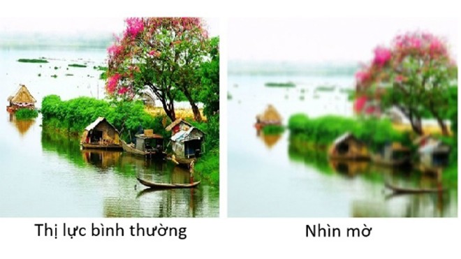 3 kiểu nhìn mờ cảnh báo nguy cơ mù lòa Đừng bỏ qua tình trạng nhìn mờ dù tình trạng này xảy ra thoáng qua hay thường xuyên.