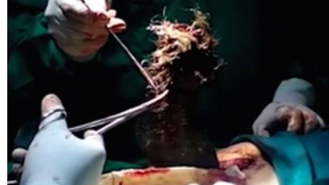 Lạnh người với búi tóc nặng gần 1 kg trong ổ bụng thiếu nữ Búi tóc được lấy ra từ dạ dày của cô gái