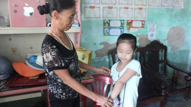 Nghi án bé gái bị bắt hụt khiến người dân giật mình thon thót Vết lằn nắm tay mà người đàn ông rủ bé Trang đi chơi vẫn còn chưa mất.
