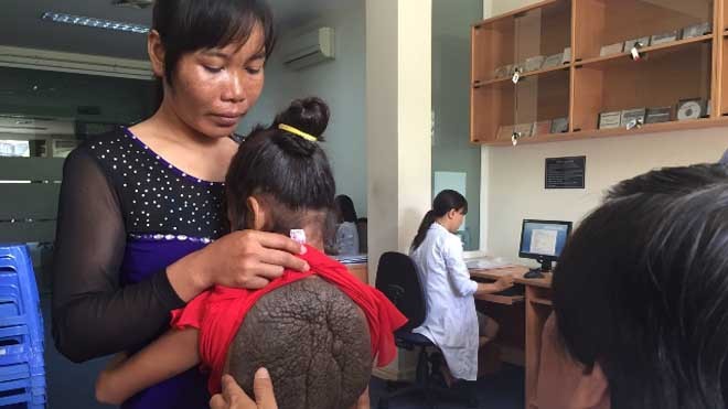 “Cô bé mai rùa” hồn nhiên trước ca mổ Hình ảnh “cô bé mai rùa” Việt Nam trước khi được phẫu thuật. Ảnh: Quốc Ngọc