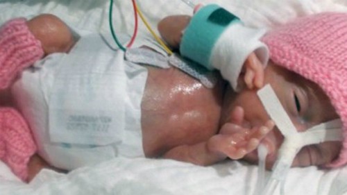 Em bé sinh non nhẹ nhất thế giới Emilia lúc mới sinh. Ảnh: CEN.