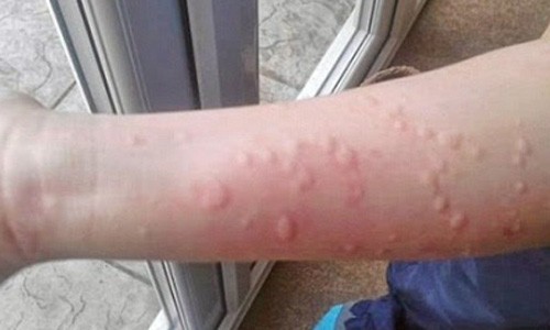 4 loại lá nổi tiếng trị mề đay hiệu quả bạn nên biết 4 loại lá nổi tiếng trị mề đay hiệu quả bạn nên biết