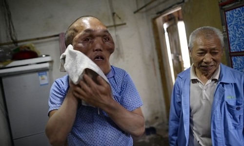 Ông lão có khuôn mặt biến dạng giống người ngoài hành tinh Hạ Nguyên Hải với khuôn mặt biến dạng khiến ông trông giống người ngoài hành tinh. Ảnh: Sun.