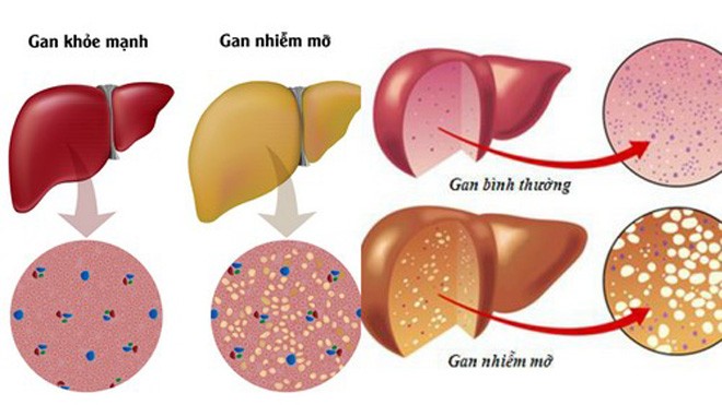 Gan nhiễm mỡ dễ dẫn đến xơ, ung thư gan Hình ảnh minh họa gan nhiễm mỡ.