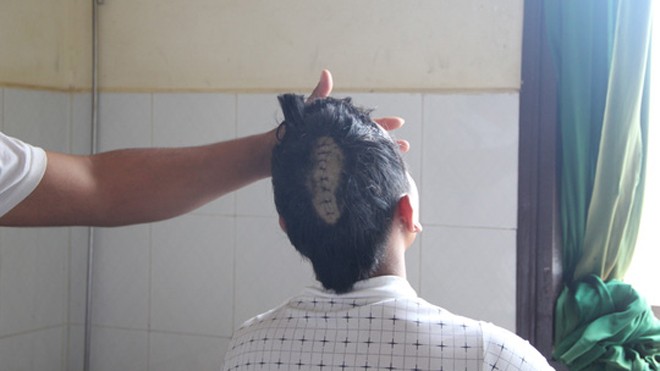 Nhóm côn đồ lao vào quán bida, chém nứt sọ khách K' Đích bị chém nứt sọ và gãy 2 ngón tay trái đang điều trị tại Bệnh viện Đa Khoa II Bảo Lộc (Lâm Đồng).