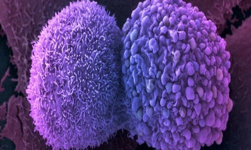 Trung Quốc chỉnh sửa gene tế bào miễn dịch để diệt ung thư Tế bào miễn dịch bị biến đổi gene có thể tấn công và phá hủy tế bào ung thư. Ảnh: Anne Weston.