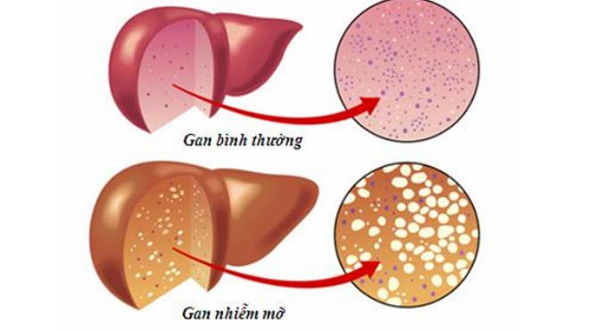 Cảnh giác dấu hiệu bệnh gan nhiễm mỡ So sánh gan khỏe và gan nhiễm mỡ.