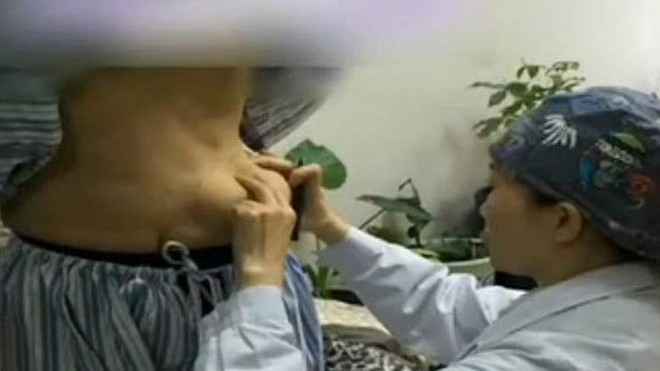 Miếng keo độn ngực trôi tuột xuống bụng sau vài năm phẫu thuật Miếng keo độn ngực trôi tuột xuống bụng sau vài năm phẫu thuật