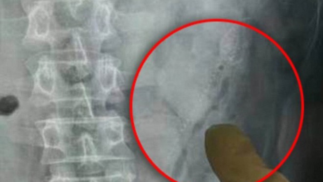 Bệnh nhân Trung Quốc thủng ruột vì cá chui vào bụng Hình chụp X quang cho thấy con cá chạch bùn nằm sâu trong khoang bụng bệnh nhân. Ảnh:Huanqiu.