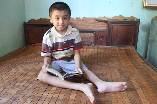 Cậu bé xương thủy tinh, 17 lần gẫy chân mơ thành lập trình viên Em Nguyễn Hữu Thanh Quang với đôi chân "thủy tinh". Ảnh: Đức Hùng