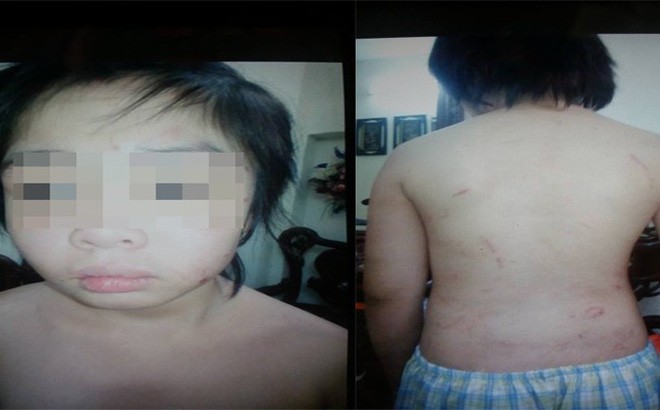 Bé trai 10 tuổi tố bố và mẹ kế đánh thương tích đầy người Những vết thương trên người cháu K.