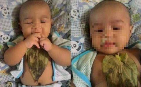 Đắp lá chữa sổ mũi, bé 6 tháng tuổi bị bỏng nặng Đắp lá chữa sổ mũi, bé 6 tháng tuổi bị bỏng nặng