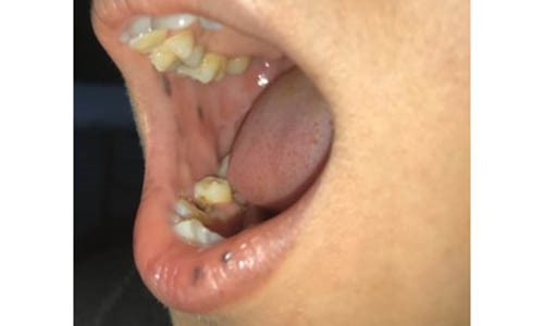 Nổi đốm sậm màu trên mặt, một phụ nữ Bến Tre mắc bệnh cực hiếm Nổi đốm sậm màu trên mặt, một phụ nữ Bến Tre mắc bệnh cực hiếm