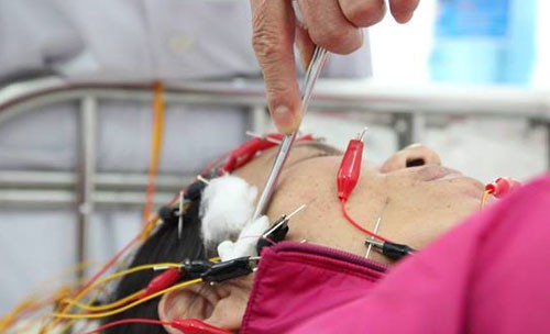 Trời rét đậm khiến nhiều người Hà Nội bị méo miệng Trời rét đậm khiến nhiều người bị liệt dây thần kinh số 7. Ảnh: L.P.