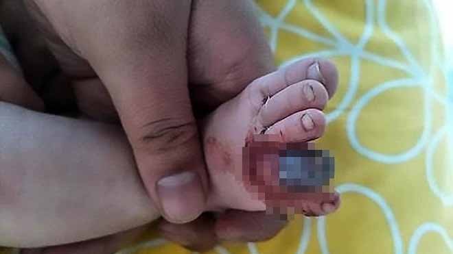 Bé trai nguy cơ mất ngón chân vì một sợi tóc Ngón chân chuyển sang màu đen do bị sợi tóc quấn chặt. Ảnh: Daily Mail.
