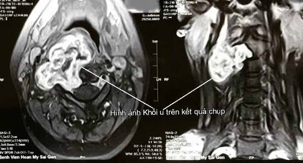 Khàn tiếng lâu năm, rất có thể do khối u vùng cổ Hình ảnh khối u trên MRI.