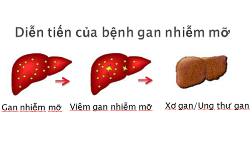 Gan nhiễm mỡ gây nhiều bệnh nguy hiểm Bệnh gan nhiễm mỡ gây viêm gan nhiễm mỡ, xơ gan và ung thư.