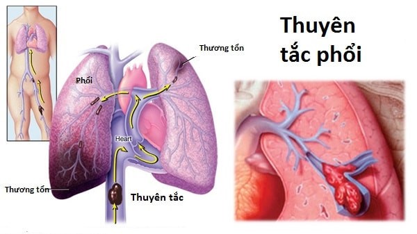 Điểm danh 'thủ phạm' gây đột tử hàng đầu ở nam giới Điểm danh 'thủ phạm' gây đột tử hàng đầu ở nam giới