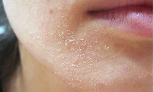 Bác sĩ da liễu cảnh báo những ngộ nhận tai hại về lột trắng da Lột trắng da làm đẹp không đúng cách coi chừng gây hại cho da.