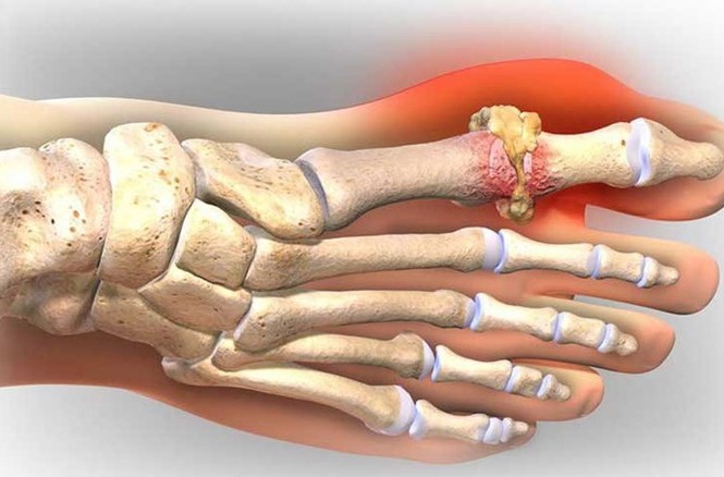 Những đồ ăn làm giảm cơn đau của người bệnh gút Những đồ ăn làm giảm cơn đau của người bệnh gút