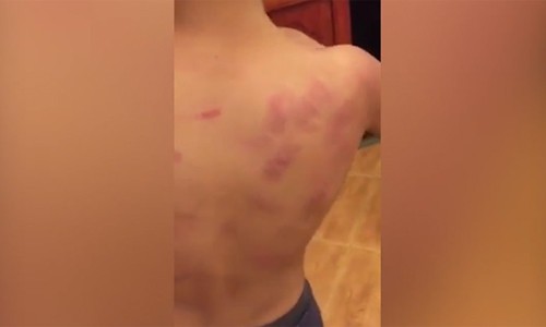 Phụ huynh tố cô giáo mầm non đánh con trai bầm tím lưng Phụ huynh tố cô giáo mầm non đánh con trai bầm tím lưng
