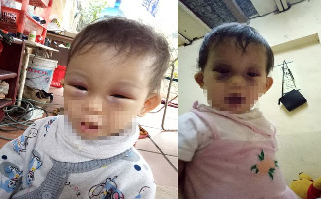 Bé gái bầm hai mắt sau khi từ trường về: Nhiều dấu hiệu lạ Cháu Thuỳ T. bị thâm tím hai bên mắt. (Ảnh: Gia đình cung cấp)