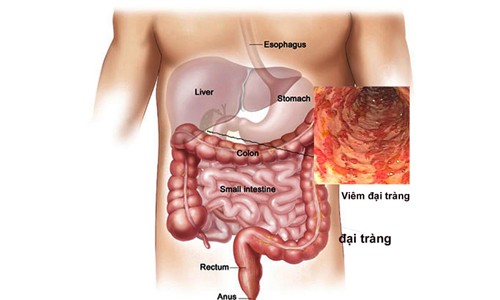 5 dấu hiệu giúp tự nhận biết sớm ung thư đại trực tràng 5 dấu hiệu giúp tự nhận biết sớm ung thư đại trực tràng