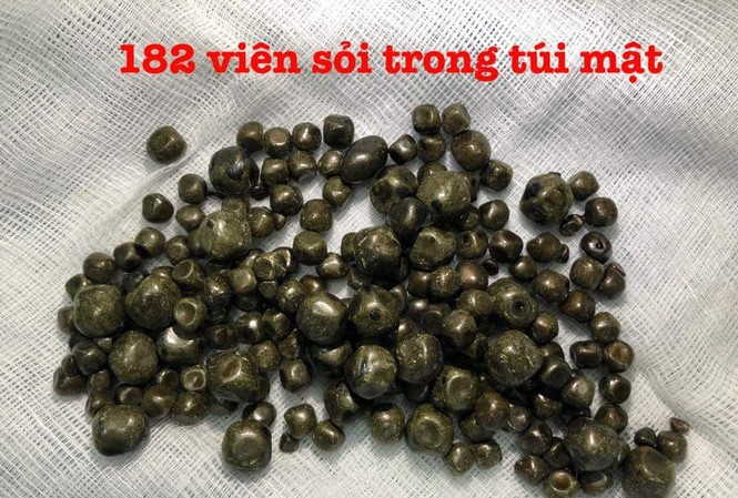 Người phụ nữ mang gần 300 viên sỏi túi mật suốt 10 năm gần 300 viên sỏi được lấy ra từ túi mật của bà Đ.