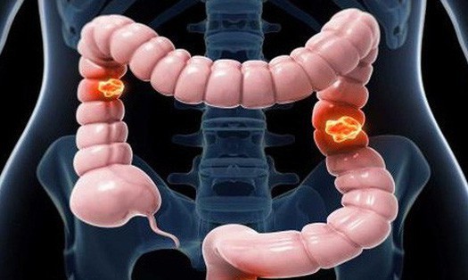 Cảnh báo nguy cơ mắc ung thư từ bệnh viêm đại tràng Ung thư đại tràng đe dọa tính mạng nhiều người