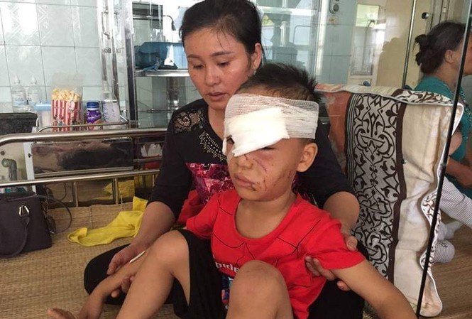 Một tuần, 3 trẻ bị chó cắn 'nát' hết mặt mũi Bệnh nhân Nguyễn Đình Đ (nhờ anh/chị che mờ ảnh mặt cháu bé)