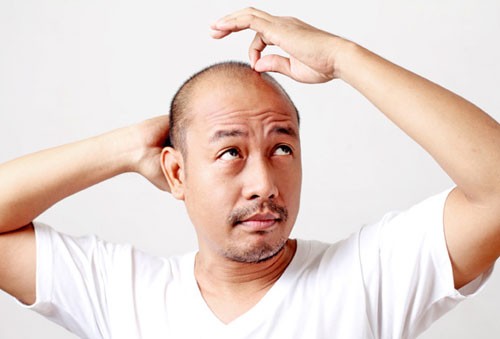 Nam giới hói đầu có nguy cơ cao bị ung thư tuyến tiền liệt Ảnh minh họa: Internet