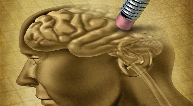 Thuốc xịt trị bệnh Alzheimer Ảnh minh họa: Internet