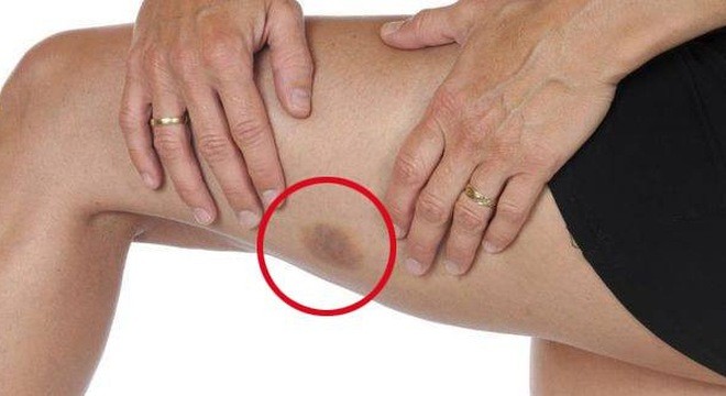 Vết bầm tím bất thường trên da cảnh báo nhiều bệnh nguy hiểm Ảnh minh hoạ: Internet