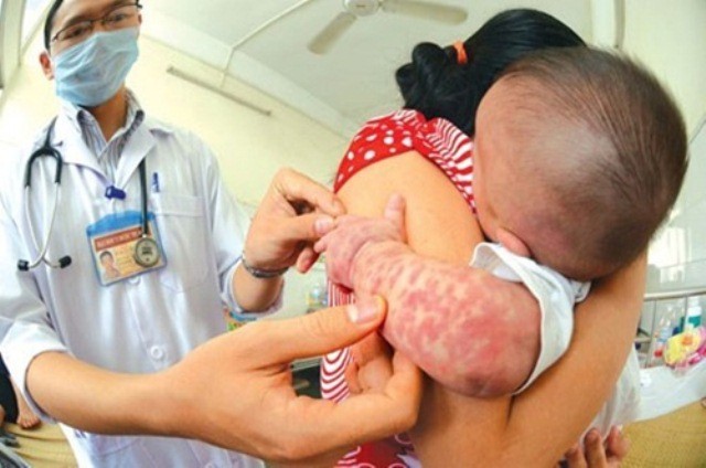 Khắp các quận huyện đều có người mắc sởi, phòng bệnh thế nào? Tiêm vắc xin là biện pháp phòng sởi đơn giản nhưng hiệu quả. Ảnh minh họa: Internet