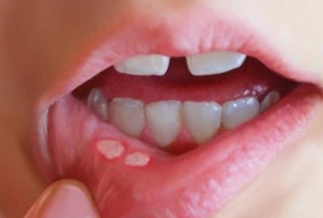 Những dấu hiệu không ngờ 'tố' bạn bị ung thư khoang miệng Ảnh minh hoạ: Internet