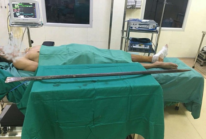 Liên tục các ca tai nạn đâm xuyên cơ thể nhập viện cấp cứu Bệnh nhân và chiếc xà beng đâm xuyên qua chân được các BS Bệnh viện E TƯ phẫu thuật lấy ra khỏi cơ thể.
